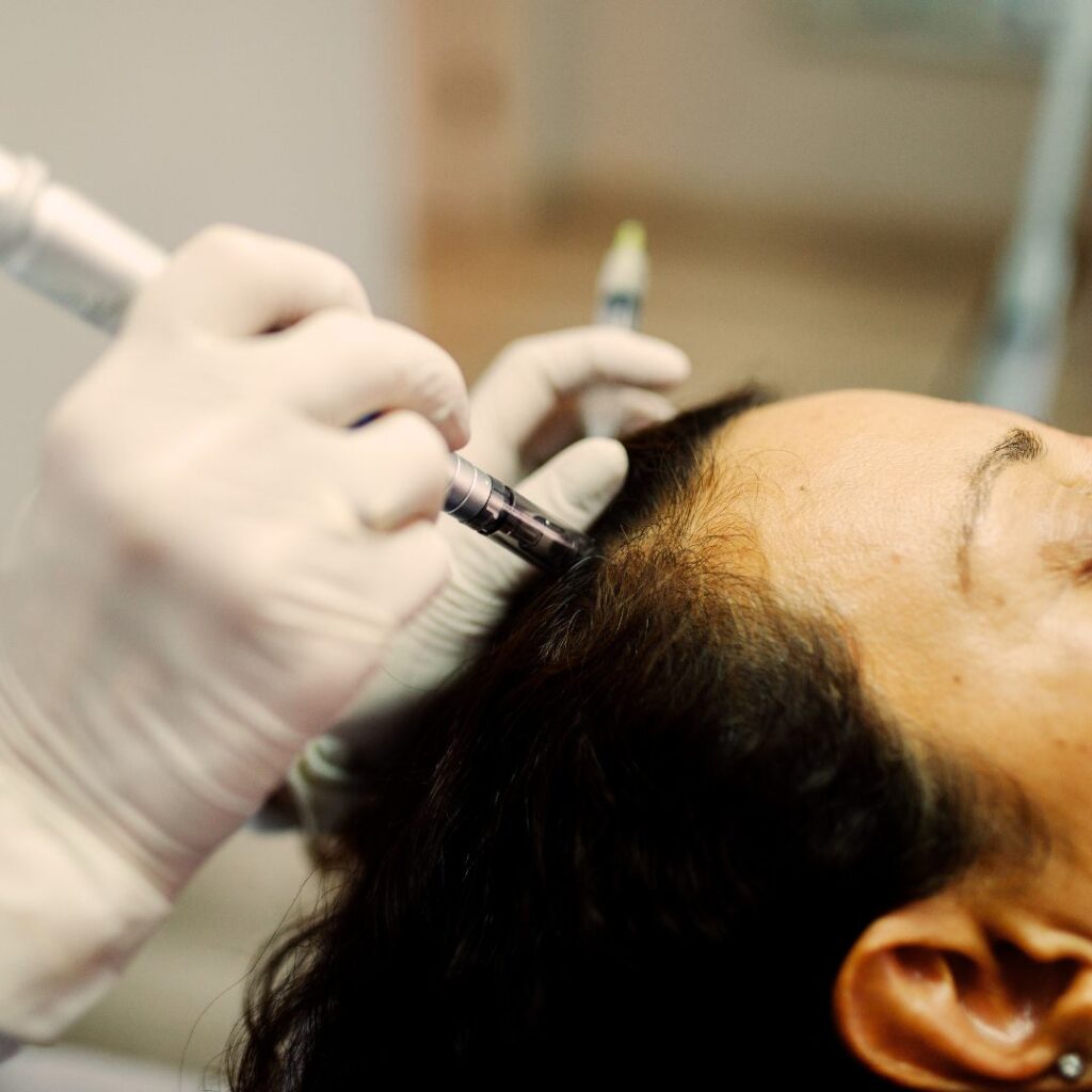 microneedling benefits for hair