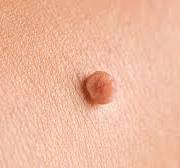 skin tag removal Bishop's Stortford